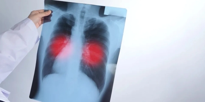 Maringá 98 FM — A Paraíba registrou 1.581 casos de tuberculose em 2025, segundo dados da Secretaria de Estado da Saúde (SES). No mesmo período, o estado contabilizou 119 mortes pela doença e manteve alta procura por diagnóstico e tratamento na rede pública. Os dados, analisados pelo g1, indicam crescimento no número de notificações ao longo dos últimos anos. Em 2022, foram registrados 1.385 casos. O total subiu para 1.504 em 2023, 1.512 em 2024 e chegou a 1.581 em 2025, um aumento de cerca de 14% no período. As mortes também apresentaram elevação gradual: 108 em 2022; 116 em 2023; 117 em 2024 [&hellip;]